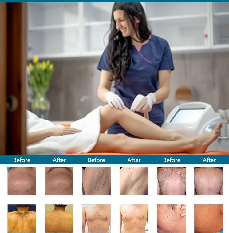 M- Beauty Machine Diode Laser Hair Removal Beauty Equipment