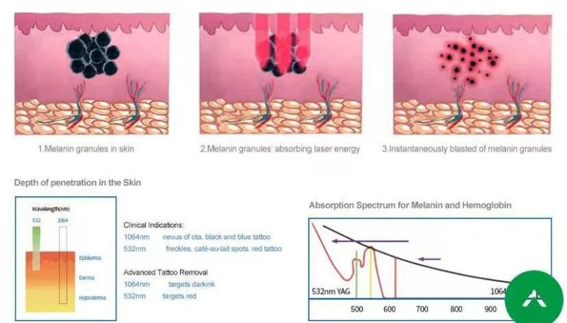 M-Pigment Removal Tattoo Removal Q Swtich YAG Laser Pigment Treatment Acne Treatment for Laser