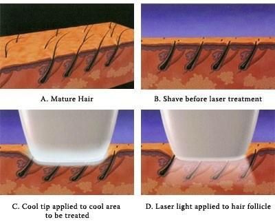 Alexandrite Laser Hair Removal Machine 1064 755nm Diode Laser Hair Removal