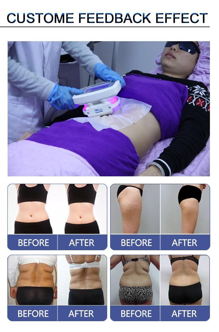 Dual Cooling System Cryolipolysis Fat Freezing Slimming Machine