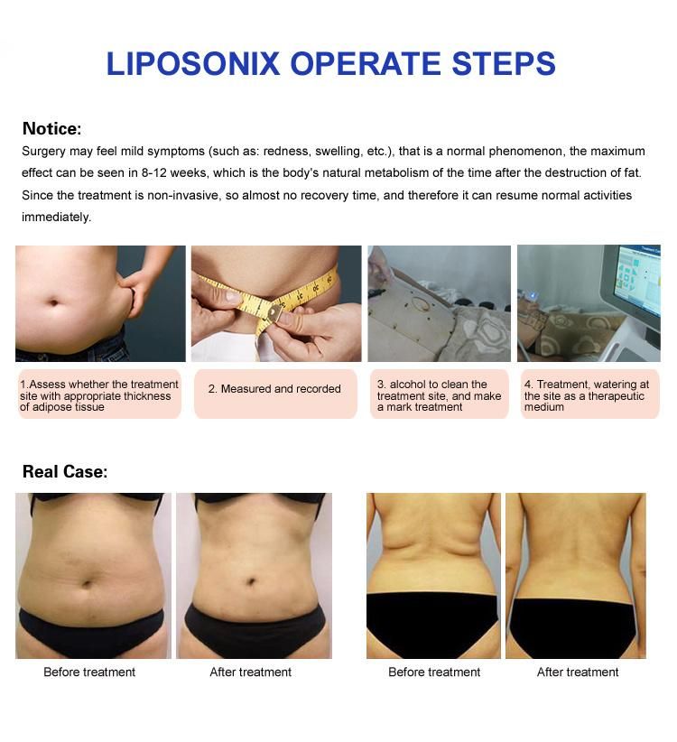 Portable Ultrasound Liposonix Machine Body Slimming Price with Liposonix Cartridge