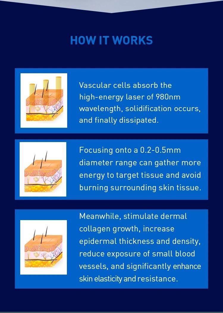 980nm Diode Laser for Spider Vein Removal