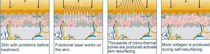 New Fractional CO2 Laser Pigmentation Removal of Scars Surgical Head 10600nm CO2 Laser Frazionato