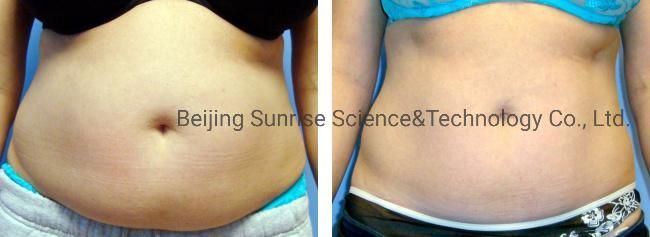 Sunrise 2022 Lipo Laser 5D Lipo Melt Laser Slimming Machine Lipo Laser Fast Slim Machine 5D Lipo Laser Machine