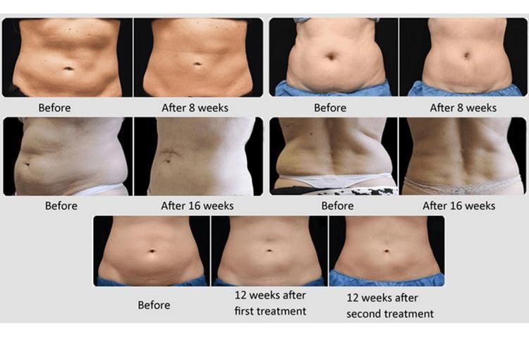 CE Approved Body Slimming Weight Loss 360 Fat Freezing Machine