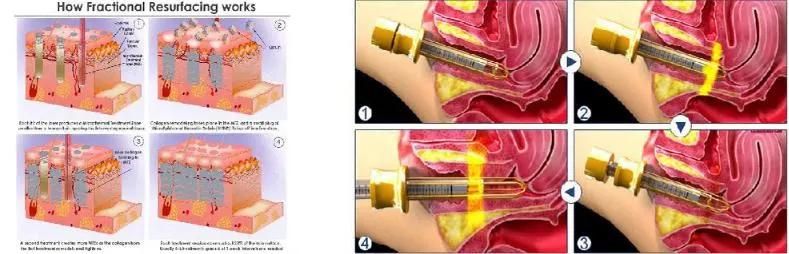 Best Selling Fractional CO2 Laser Skin Resurfacing / CO2 Fractional Laser Vaginal Tightening