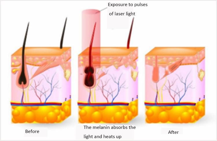 IPL Shr Laser Hair Removal Machine Skin Rejuvenation Machine