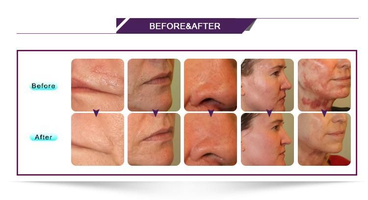 RF Fractional CO2 Laser for Scar Removal