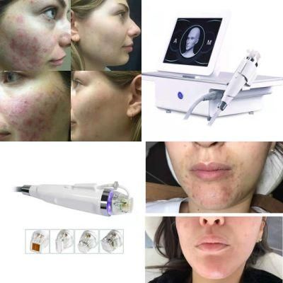 Multifunctional Stretch Marks Acne Wrinkle Removal Fractional RF Microneedle Machine