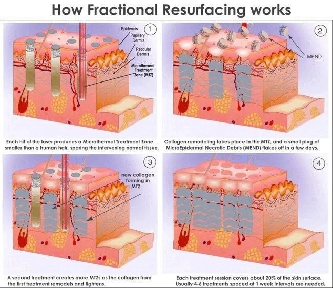 Fractional CO2 Laser Vaginal Rejuvenation& Skin Care Medical Beauty Equipment