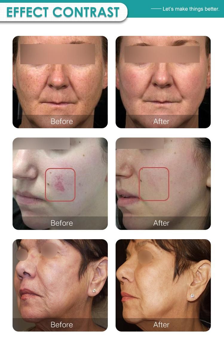 FDA Approved Medical and Beauty Device CO2 Fractional Laser