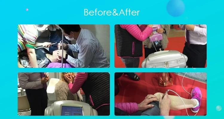 980nm Diode Laser for Spider Veins Removal and Vascular Removal