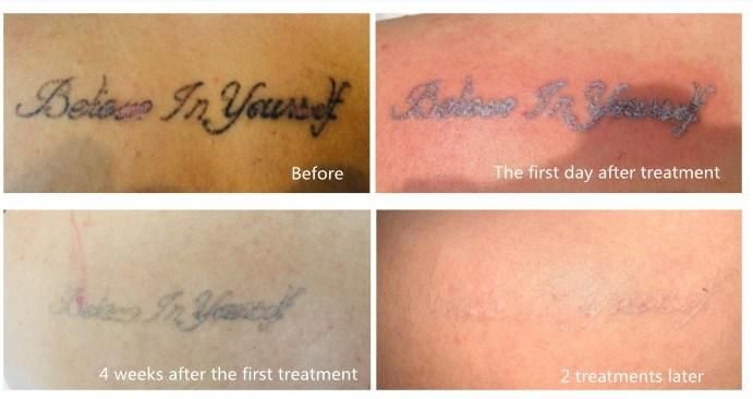 Laser Freckle Removal Permanent Sunrise Pigmentation Therapy CE ND YAG Picosecond Laser Machine Tattoo Removal