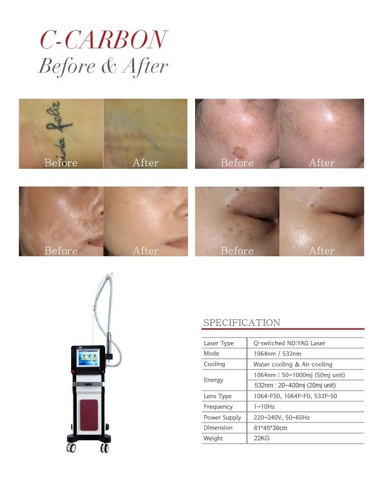 Portable Q-Switched ND YAG Laser Tattoo Removal/ Carbon Peeling Machine