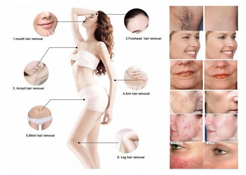 Clinic Use Shr IPL Epilator Equipment Hotsale Fast Hair Removal Opt Shr Laser/IPL Shr/Shr E Light/Shr IPL Skin Rejuvenation