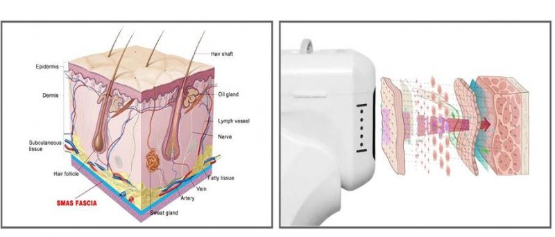 Ultrasonic Mini Hifu Skin Rejuvenation RF Face Liftiing Beauty Machine Face Lifting Anti Aging Hifu 5dhifu 3 in 1 Device