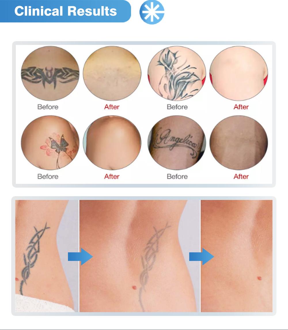 1320nm ND YAG Skin Rejuvenation and Removal Tattoo Machine