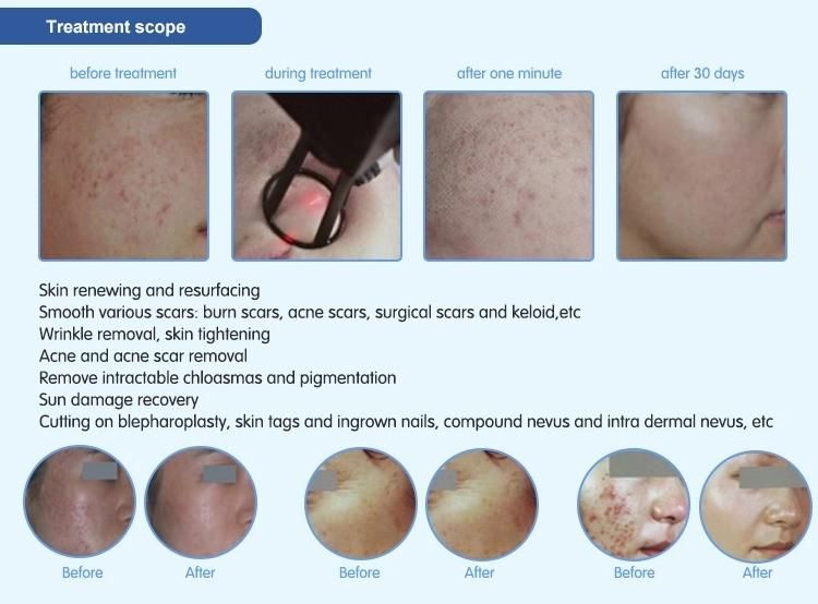 Laser Medical Equipment Scar Removal Machine Laser