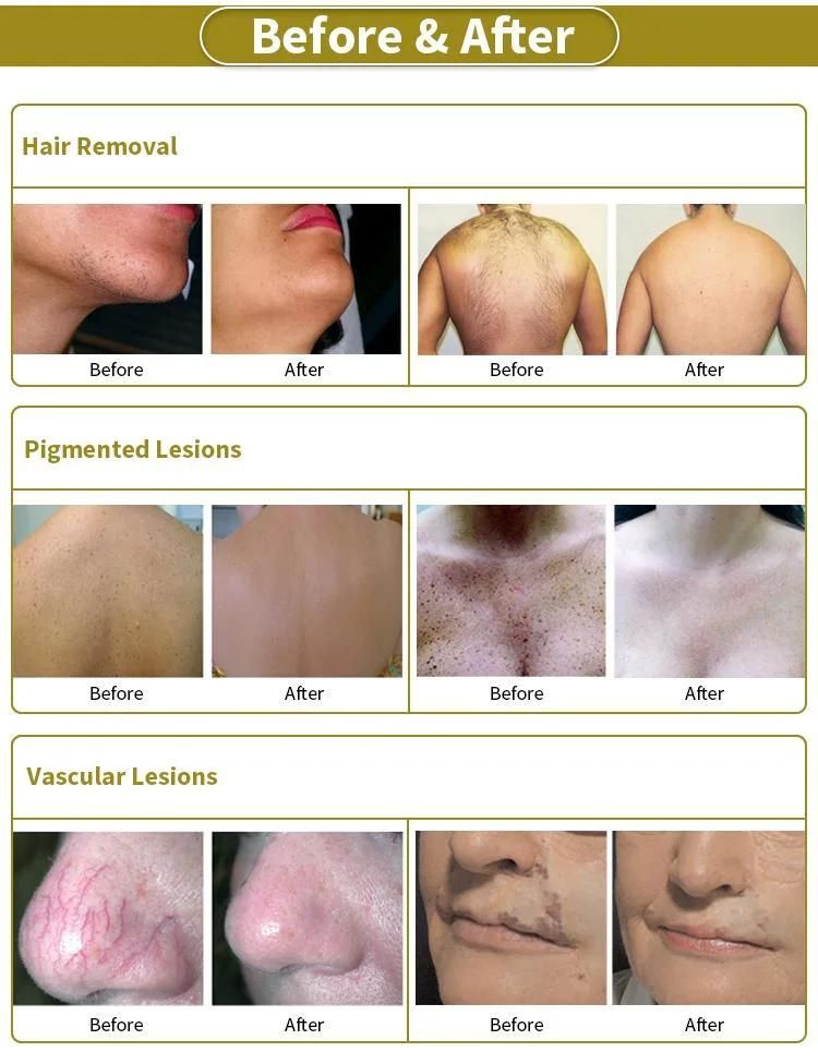 Sincoheren Alex Laser Hair Removal 1064 755 Alexandrite Laser Instrument Ndyag Gentle PRO Laser