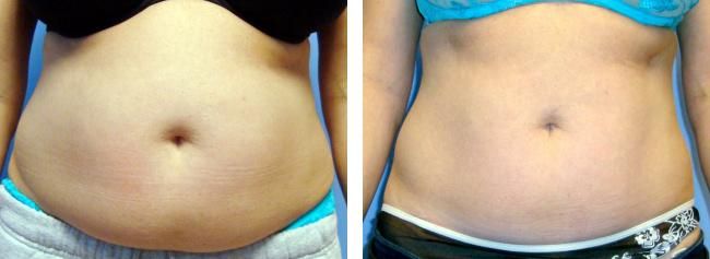 2022 Newest Laser 5D Lipo Laser Body Slimming Reduction Laser Slim Lipo Lipolysis Machine