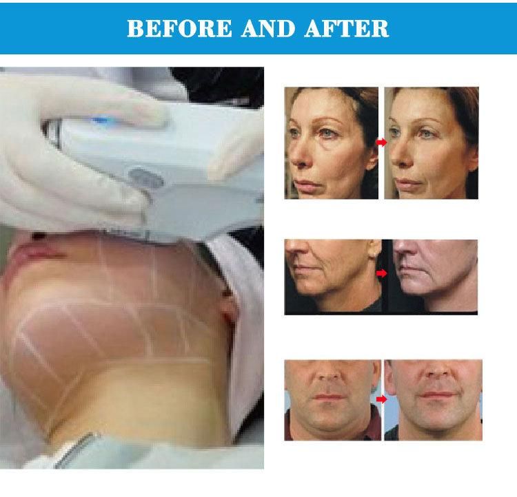 Portable RF Ultrasound Anti-Aging Face Lifting Beauty Machine