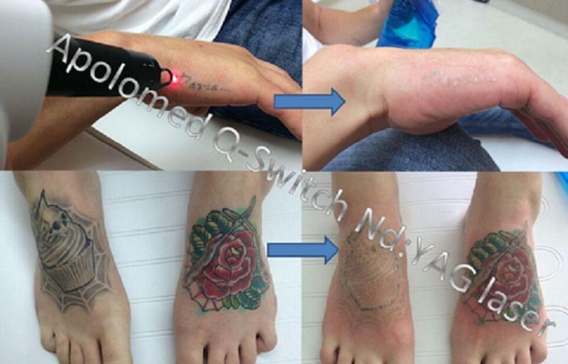 1064 Laser Peeling Device Tattoo and Pigment Removal with 1064 / 532nm Q-Switch ND YAG Laser