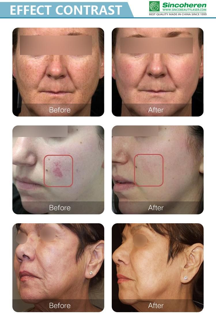 Latest Fotona Clinical Medical CO2 Fractional Laser Treatment Equipment