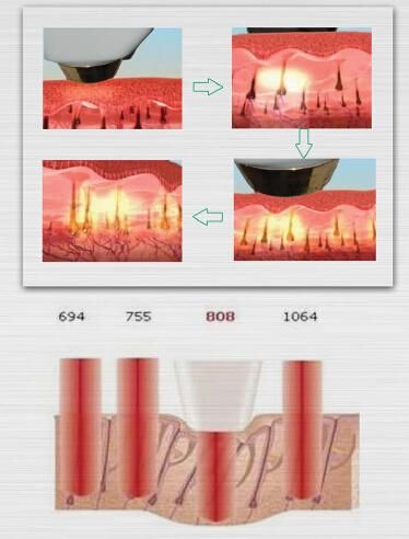 808nm Diode Hair Removal