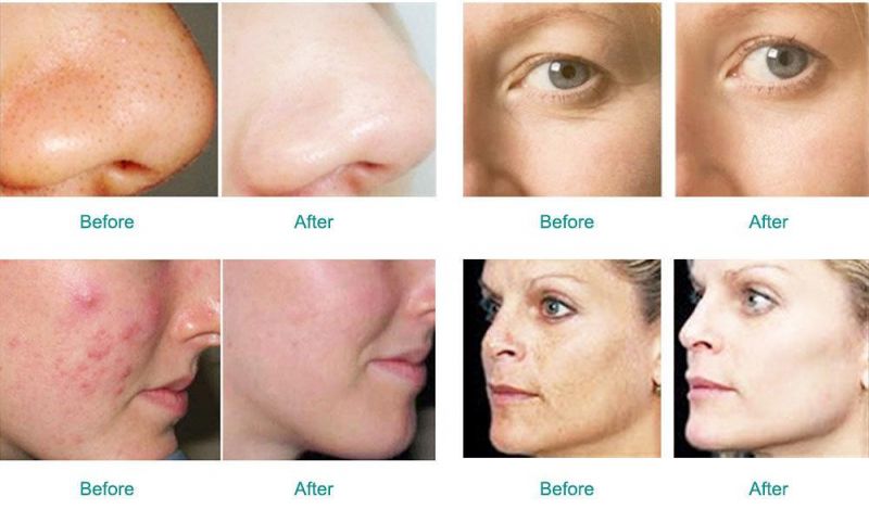 PDT LED 9in1 Skin Care Face Cleaner Hydra Peeling Skin Rejuvenation Face Lift Blackhead Remover Dermabrasion