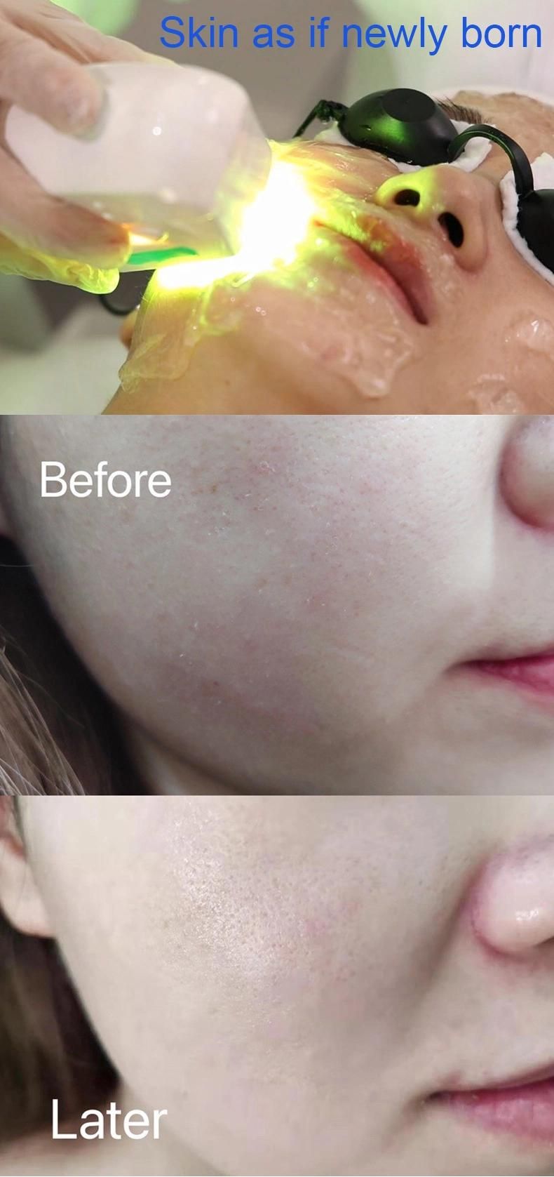 Photoperiod Promotes The Catabolism of Pigment Nir Milk Can Enhance The Function of Blood Vessel Skin Whitening 2022 New Nir Laser