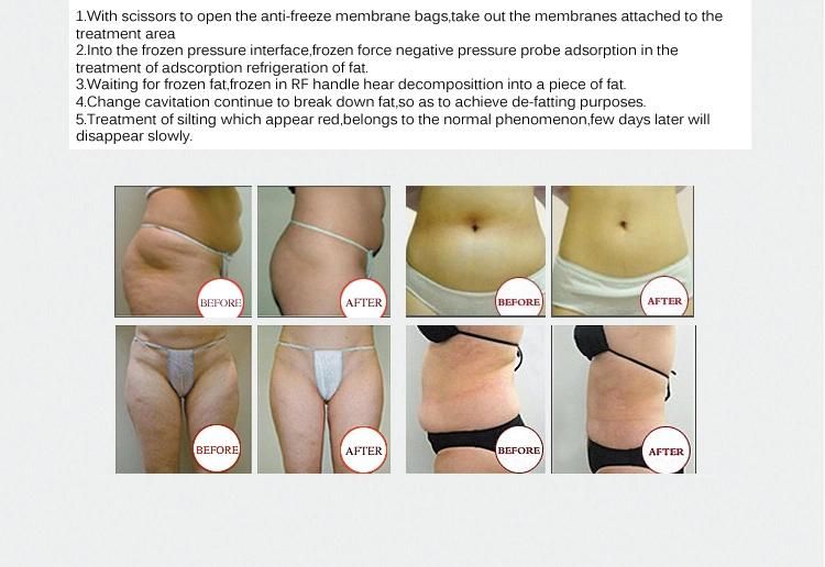 High Quality 3 Cryo Handles Cryolipolysis Fat Freezing Slimming Machine Price