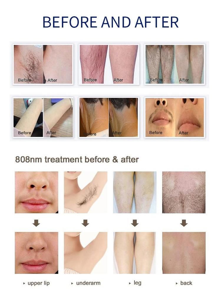 Depilation Permanent Hair Removal for Salon Hair Removal Diode Laser