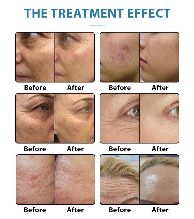 Microneedle RF Wrinkle Removal Skin Rejuvenation