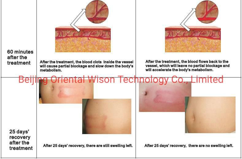 Cryolipolysis Vacuum Handle Liposuction Body Slimming Fat Removal