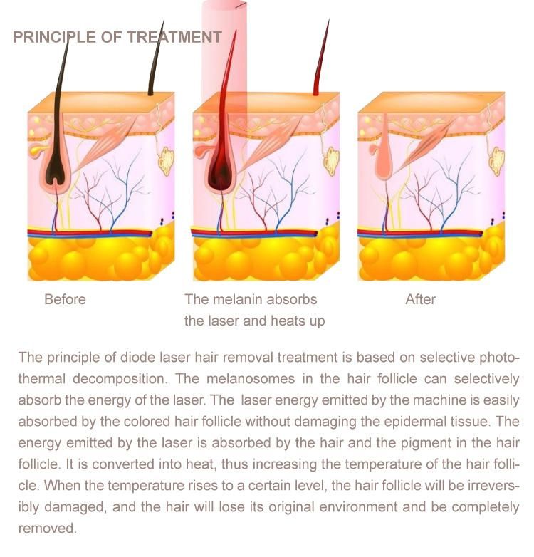 Diamond New Design 1600W Diode Machine Laser 755 808 1064 Hair Removal 1064nm Laser Epilation Diode