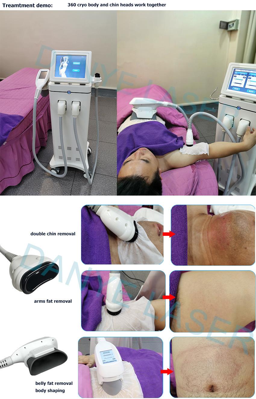 Weight Loss 360 Cryolipolysis Cellulite Reduction Machine Fat Freezing 2 Handles Simultaneous