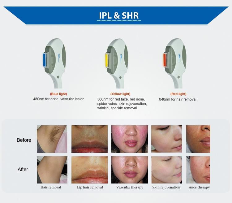 IPL System Opt Shr Hair Removal Vertical Machine