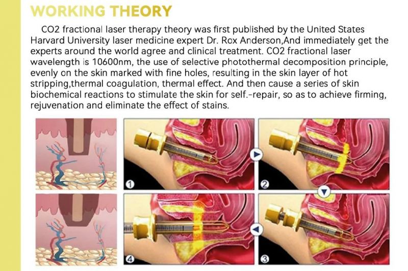 CO2 Laser Medical Machine Scar Removal with FDA TUV Tga