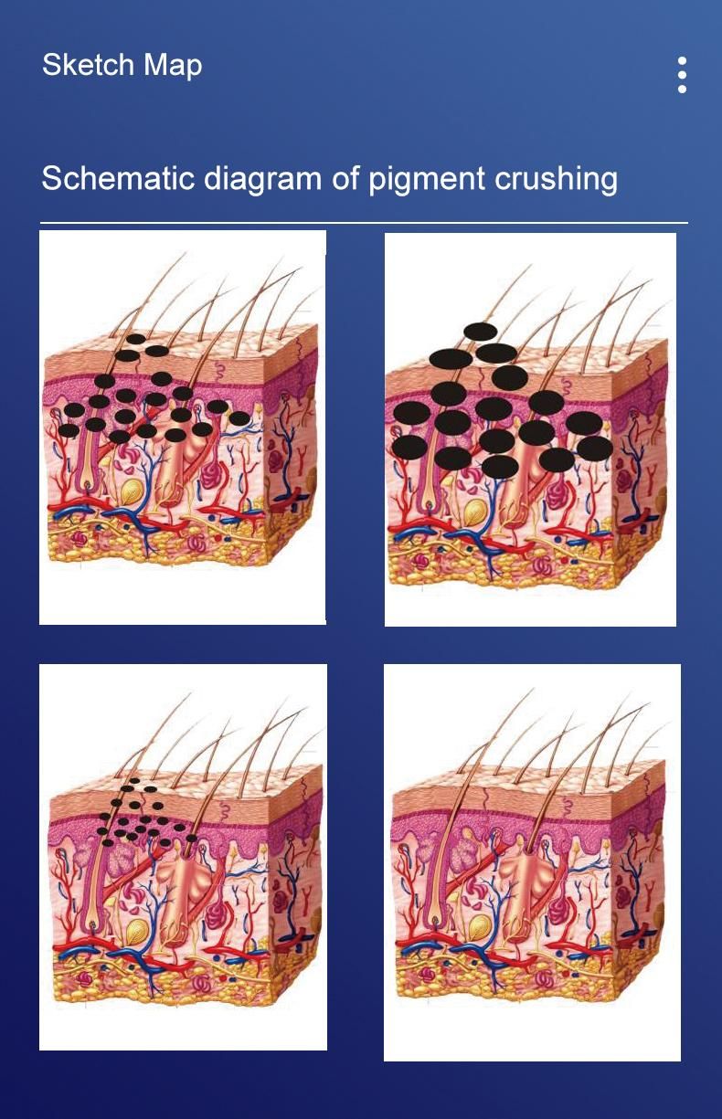 Manufacture Hair Removal Manufacture Q Switch ND YAG Laser Tattoo Removal Pigmentation Removal