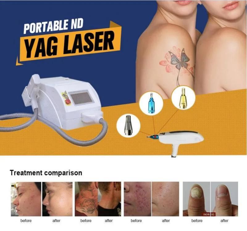 532nm 1064nm 1320nm Carbon Laser Skin Care Tattoo Removal Laser Machine Birthmark Removal