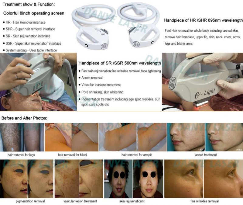 Professional Skin Rejuvenation Laser Equipment B3 Skin Whitening Hair Removal IPL Laser Shr