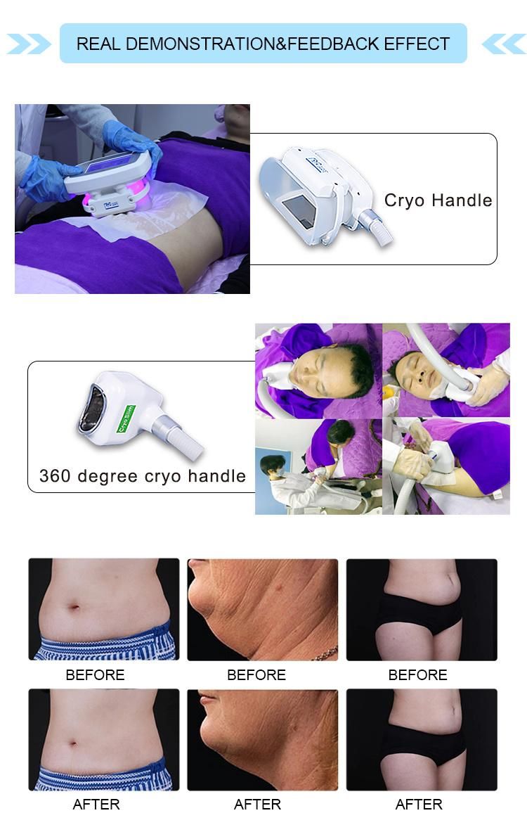 5 Cryo Handle Fat Freezing Cold Body Slimming Machine