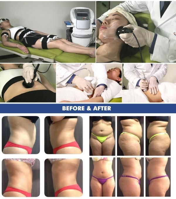 Sculpsure Laser 1064 Nm Cellulite Removal with Good Result