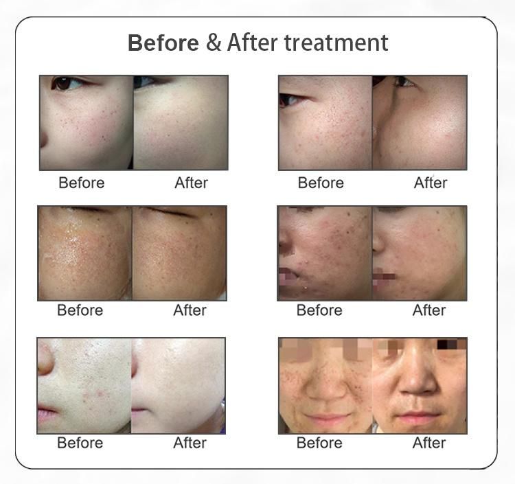 E-Light Dpl Shr Skin Rejuvenation and Acne Treatment