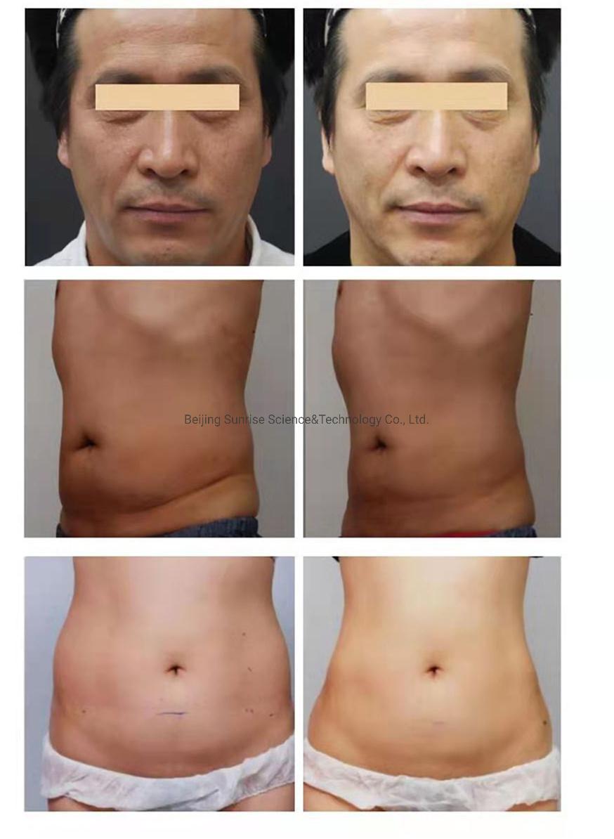 30000 Shots Korea Technology Painless Anti Wrinkle Skin Tightening Body Slimming Face Lift Beauty 7D Hifu Machine