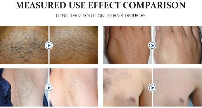 Trio 808 755 1064 Diode Laser Hair Removal for All Skin Colors Medical CE Approved