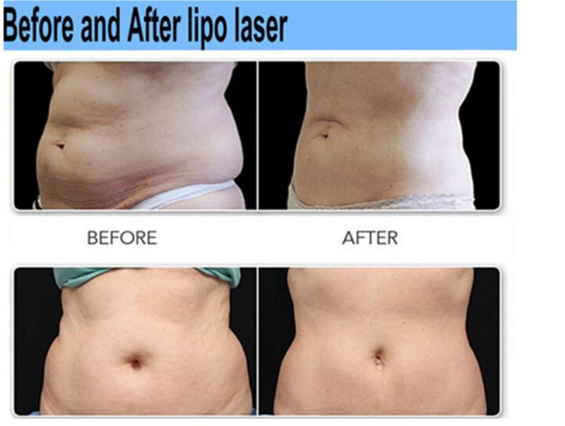 Lipo Laser Pads Liposuction Beauty Slimming Equipment for Weight Loss