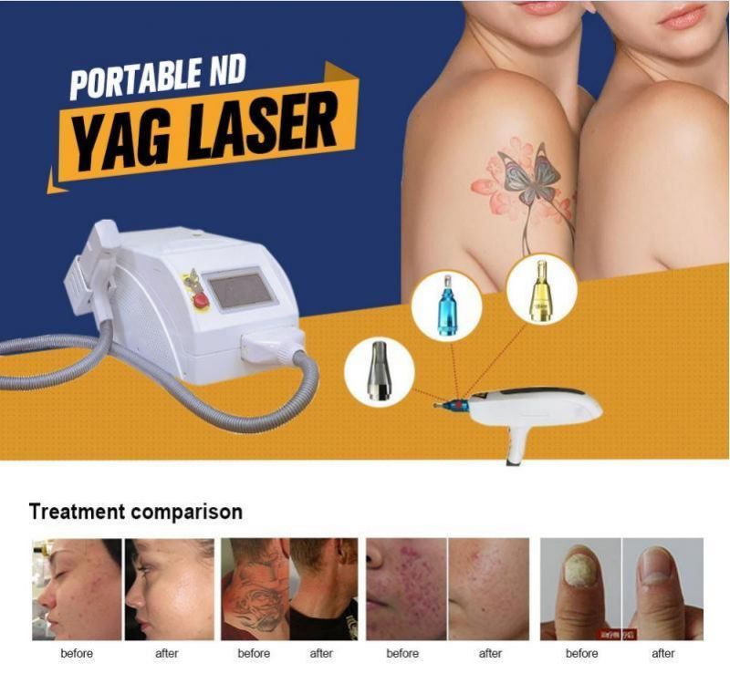 Sincoheren Mini ND-YAG Laser Tattoo Removal Laser Machine Skin Care Birthmark Removal