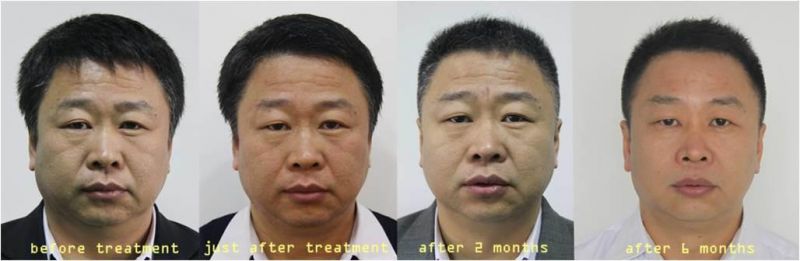 Monopolar RF Face Lifting Eye Wrinkle Removal Forhead Wrinkle Removal The Return to Youth Look