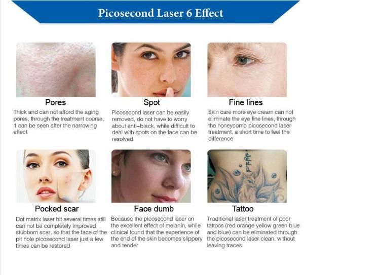 2022 Laser Effective and Safe Tattoo Removal Picosecond Machine